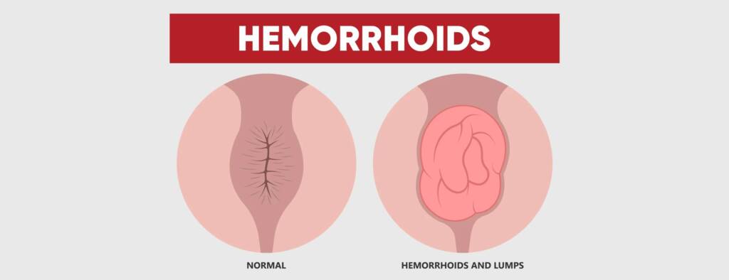 External Hemorrhoids