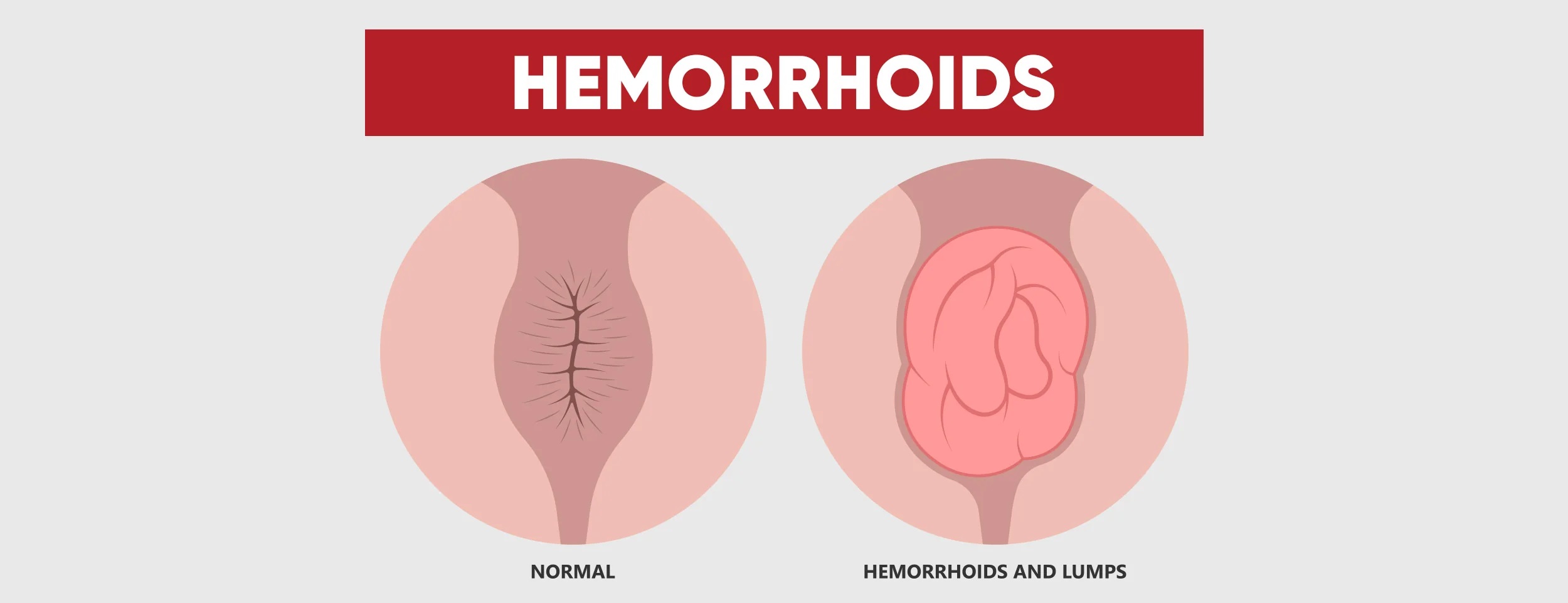 External Hemorrhoids